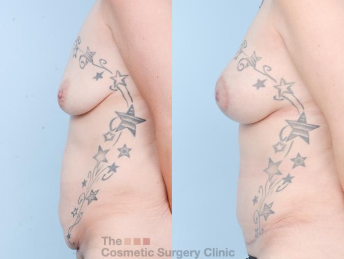 Before & After Mommy Makeover Case 878 Left Side View in Waterloo, Ontario