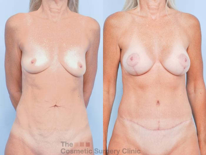 Before & After Mommy Makeover Case 914 Front View in Waterloo, Ontario