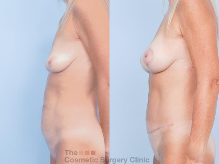 Before & After Mommy Makeover Case 914 Left Side View in Waterloo, Ontario