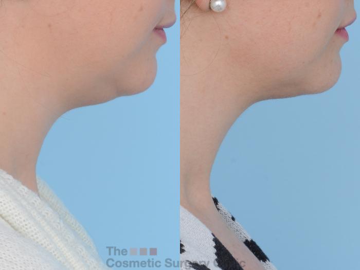 Before & After Non-Surgical Injectables Case 159 View #2 View in Waterloo, Ontario