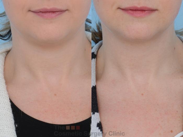 Before & After Non-Surgical Injectables Case 159 View #3 View in Waterloo, Ontario