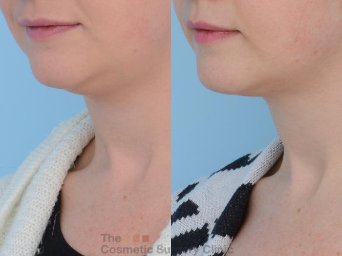 Before & After Non-Surgical Injectables Case 159 View #4 View in Waterloo, Ontario