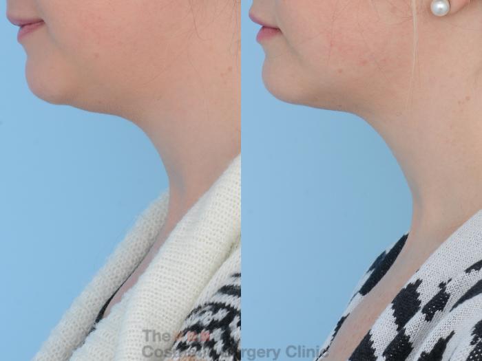 Before & After Non-Surgical Injectables Case 159 View #5 View in Waterloo, Ontario