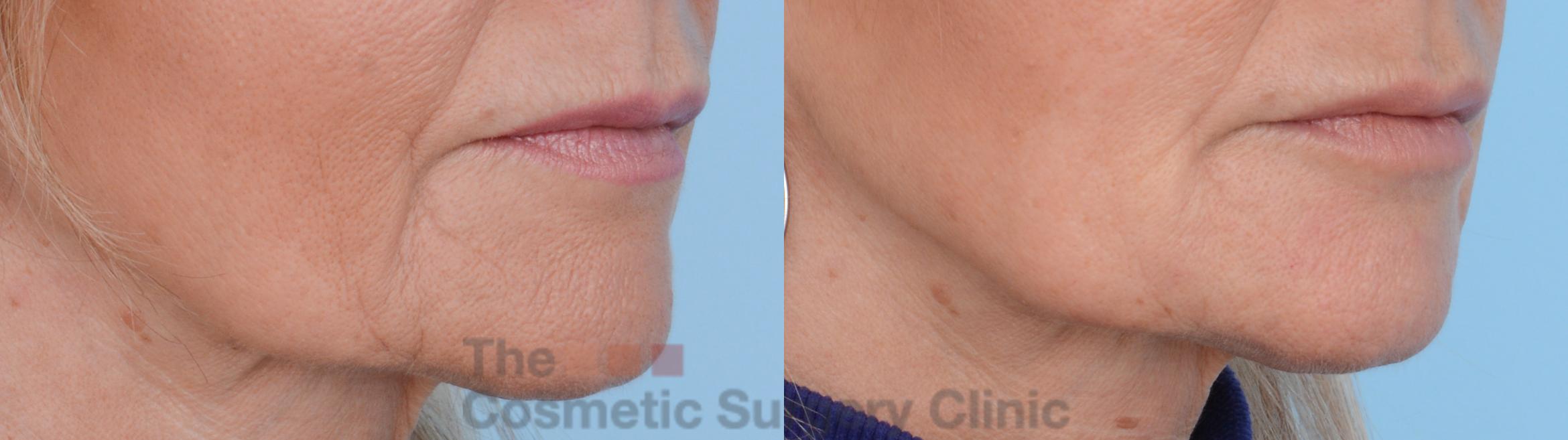 Before & After Non-Surgical Injectables Case 175 View #2 View in Waterloo, Ontario