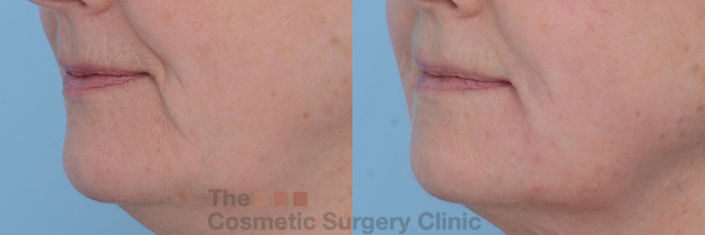 Before & After Non-Surgical Injectables Case 196 View #2 View in Waterloo, Ontario