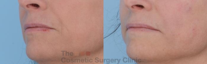 Before & After Non-Surgical Injectables Case 247 View #2 View in Waterloo, Ontario
