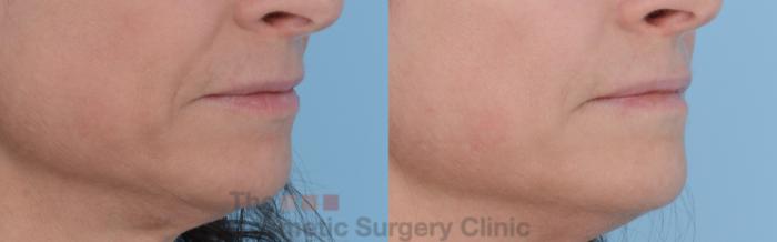 Before & After Non-Surgical Injectables Case 247 View #3 View in Waterloo, Ontario