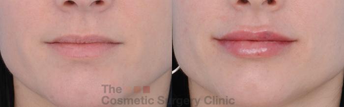 Before & After Non-Surgical Injectables Case 262 View #1 View in Waterloo, Ontario