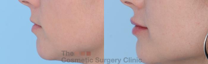 Before & After Non-Surgical Injectables Case 262 View #2 View in Waterloo, Ontario