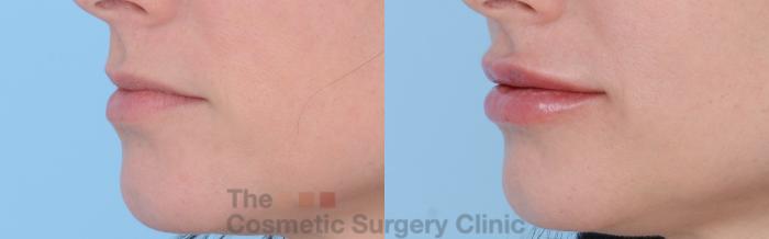 Before & After Non-Surgical Injectables Case 262 View #3 View in Waterloo, Ontario