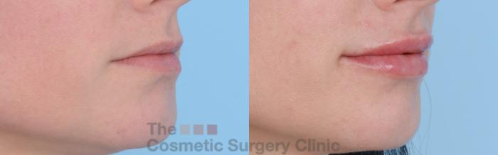 Before & After Non-Surgical Injectables Case 262 View #4 View in Waterloo, Ontario