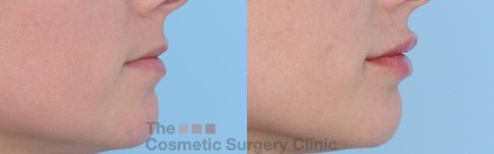 Before & After Non-Surgical Injectables Case 262 View #5 View in Waterloo, Ontario