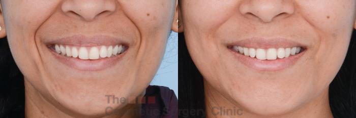 Before & After Non-Surgical Injectables Case 470 View #1 View in Waterloo, Ontario