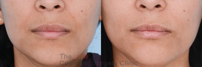 Before & After Non-Surgical Injectables Case 470 View #2 View in Waterloo, Ontario