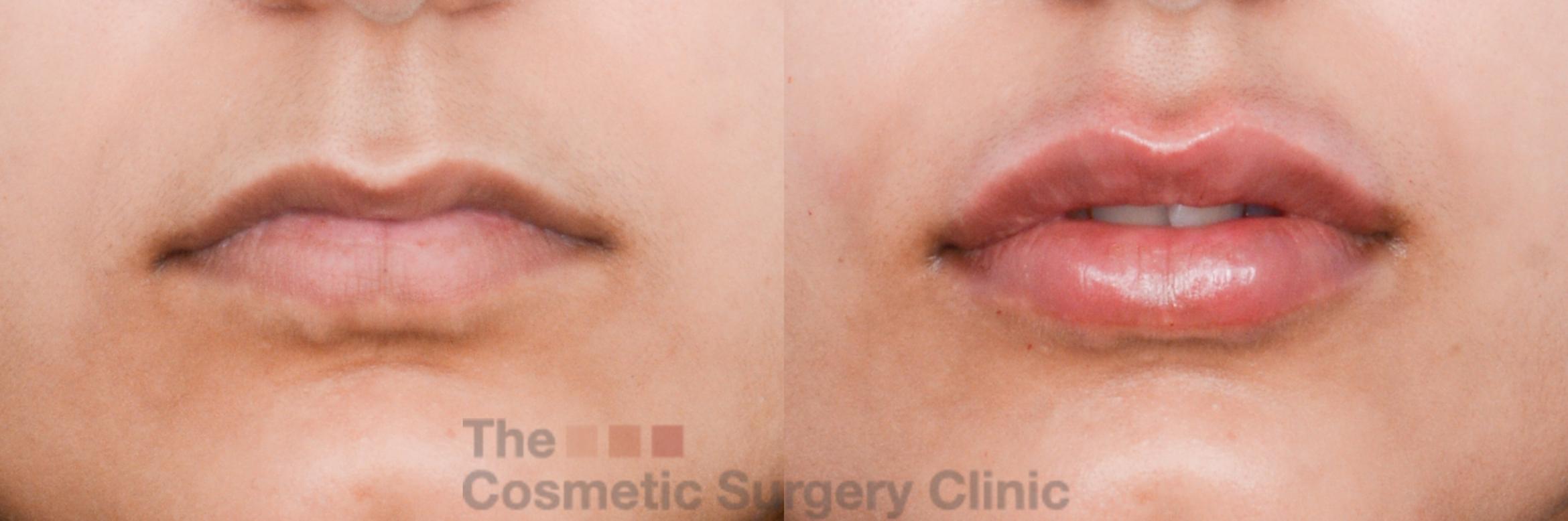Before & After Non-Surgical Injectables Case 843 Front View in Waterloo, Ontario