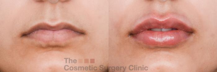 Before & After Non-Surgical Injectables Case 843 Front View in Waterloo, Ontario