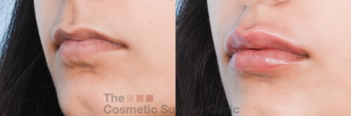 Before & After Non-Surgical Injectables Case 843 Left Oblique View in Waterloo, Ontario