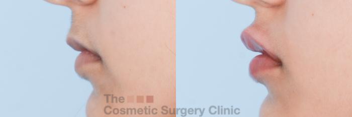 Before & After Non-Surgical Injectables Case 843 Left Side View in Waterloo, Ontario