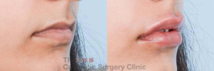 Before & After Non-Surgical Injectables Case 843 Right Oblique View in Waterloo, Ontario