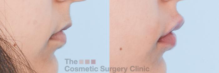 Before & After Non-Surgical Injectables Case 843 Right Side View in Waterloo, Ontario