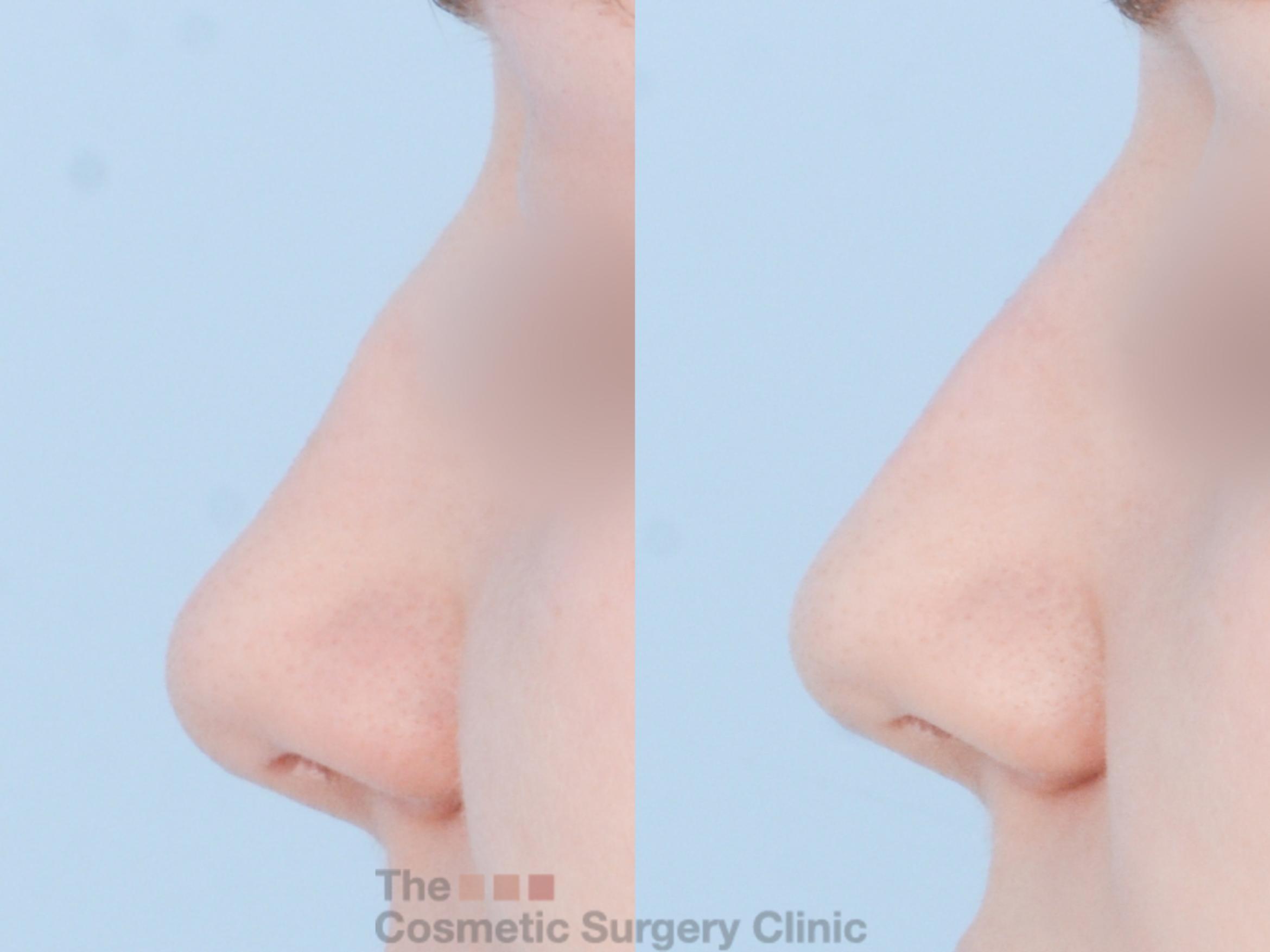 Before & After Non-Surgical Rhinoplasty (nose shaping) Case 869 Left Side View in Waterloo, Ontario