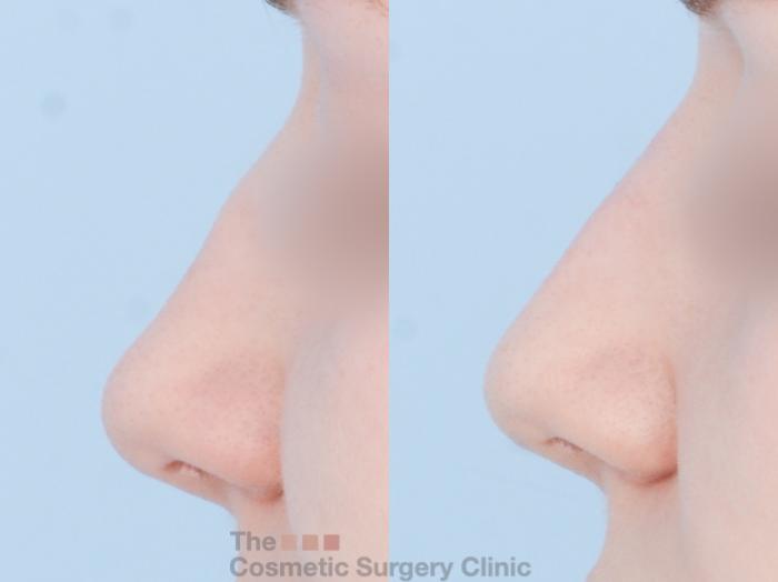 Before & After Non-Surgical Rhinoplasty (nose shaping) Case 869 Left Side View in Waterloo, Ontario