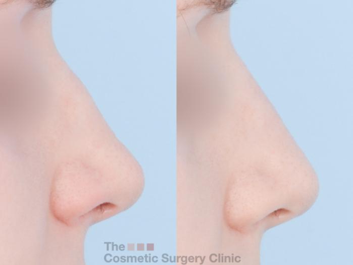 Before & After Non-Surgical Rhinoplasty (nose shaping) Case 869 Right Side View in Waterloo, Ontario