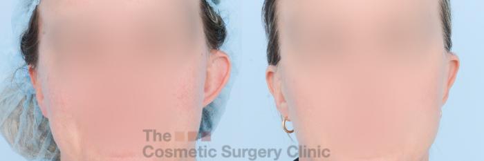 Before & After Otoplasty (Ear Pinning) Case 828 Front View in Waterloo, Ontario
