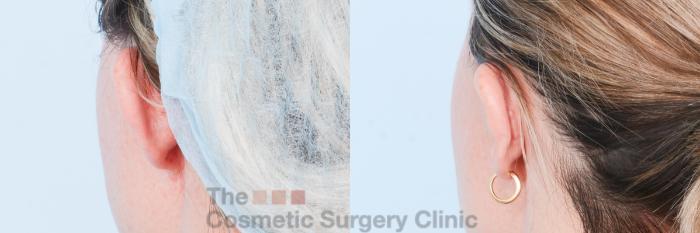 Before & After Otoplasty (Ear Pinning) Case 828 Left Back Oblique View in Waterloo, Ontario