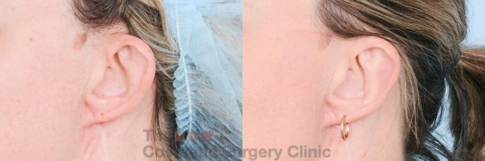 Before & After Otoplasty (Ear Pinning) Case 828 Left Oblique View in Waterloo, Ontario