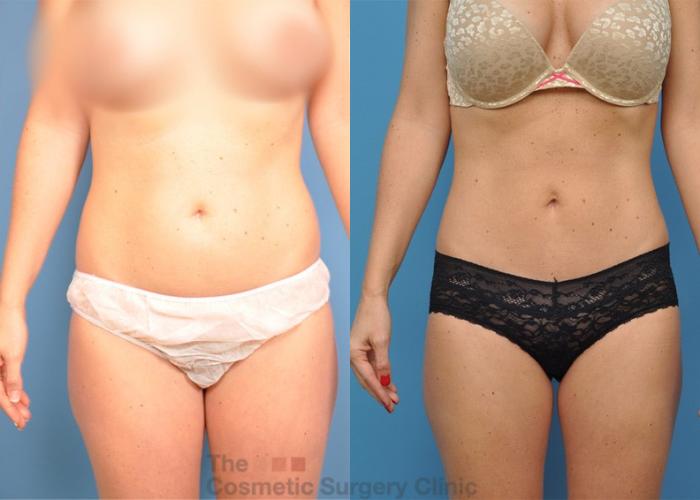 Before & After Tummy Tuck Case 22 View #1 View in Waterloo, Ontario