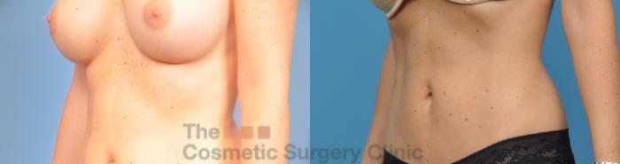 Before & After Tummy Tuck Case 22 View #2 View in Waterloo, Ontario