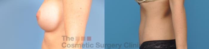 Before & After Tummy Tuck Case 22 View #3 View in Waterloo, Ontario