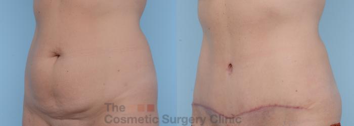 Before & After Tummy Tuck Case 267 View #3 View in Waterloo, Ontario