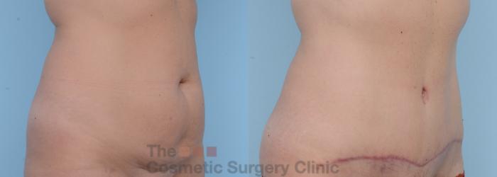 Before & After Tummy Tuck Case 267 View #4 View in Waterloo, Ontario