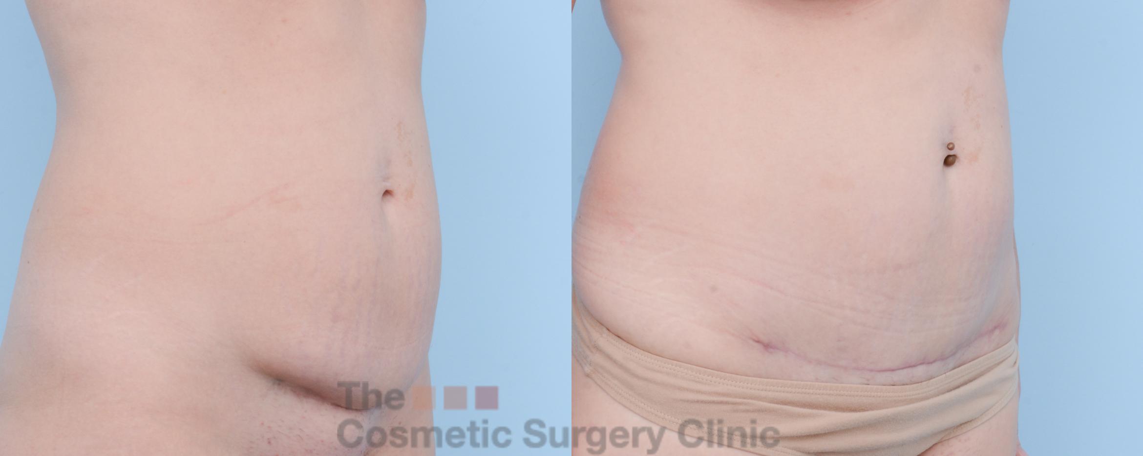 Before & After Tummy Tuck Case 301 View #4 View in Waterloo, Ontario
