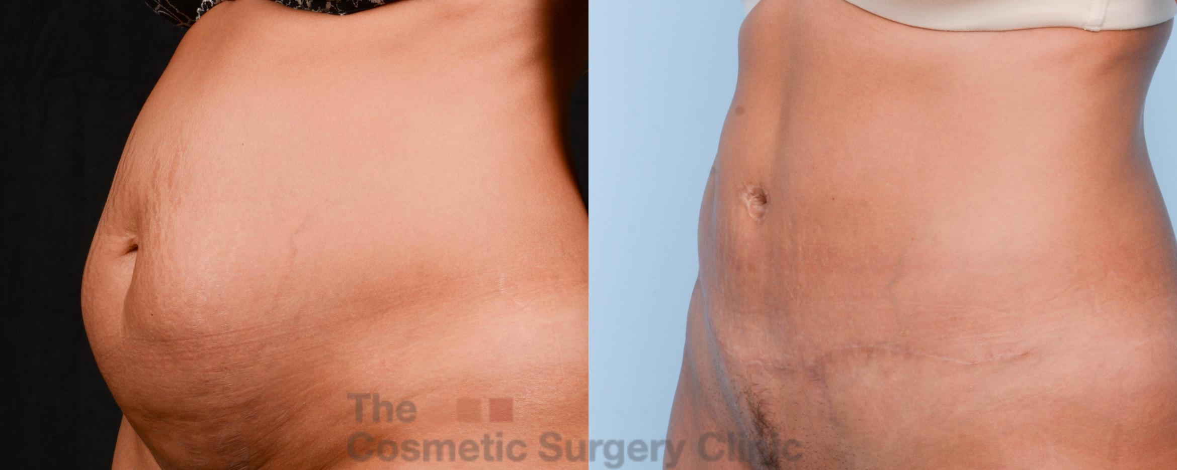 Before & After Tummy Tuck Case 308 View #3 View in Waterloo, Ontario