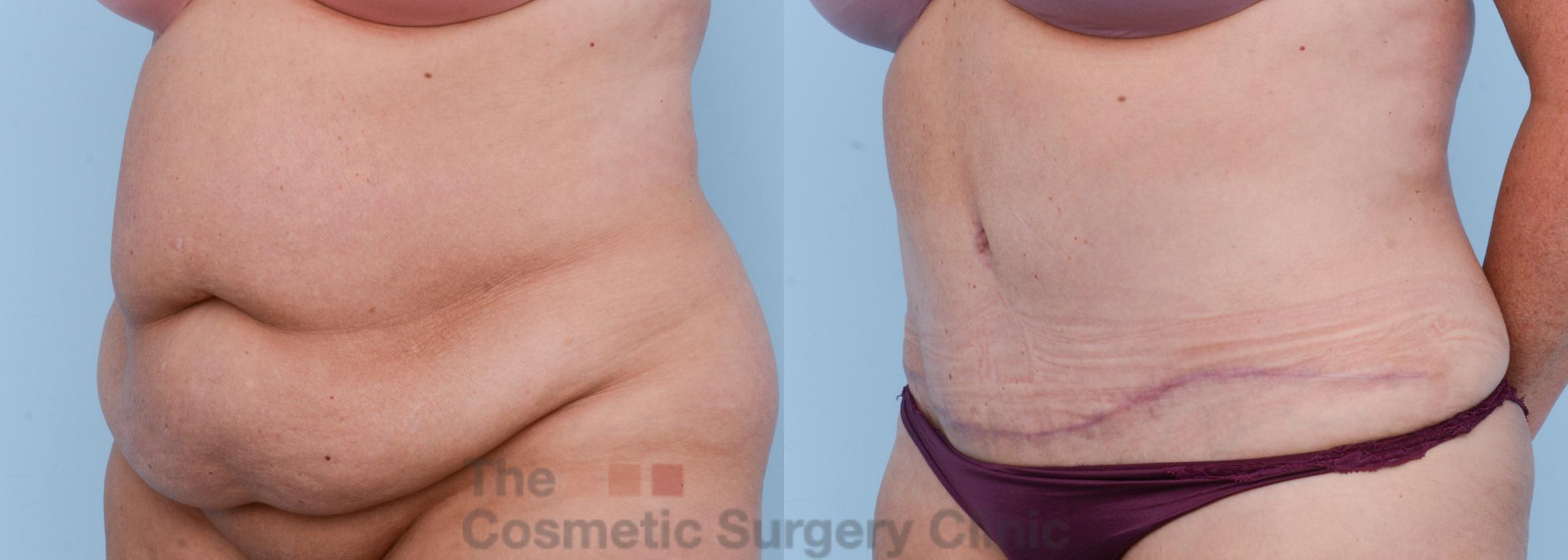 Before & After Tummy Tuck Case 393 View #3 View in Waterloo, Ontario