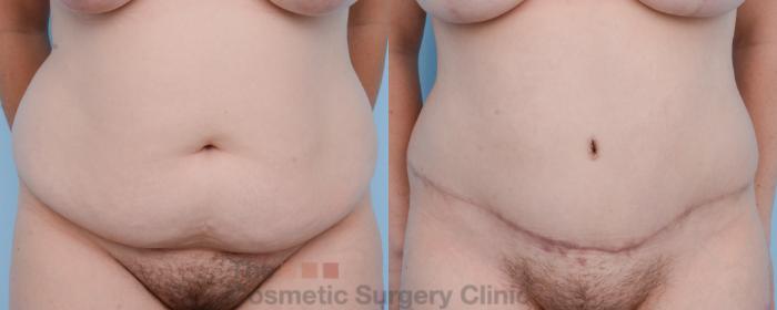 Before & After Tummy Tuck Case 457 View #1 View in Waterloo, Ontario