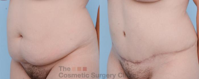 Before & After Tummy Tuck Case 457 View #2 View in Waterloo, Ontario