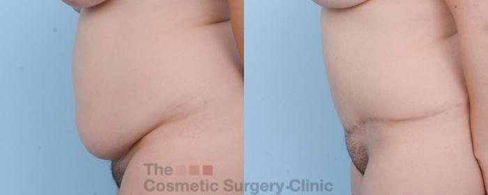 Before & After Tummy Tuck Case 457 View #3 View in Waterloo, Ontario