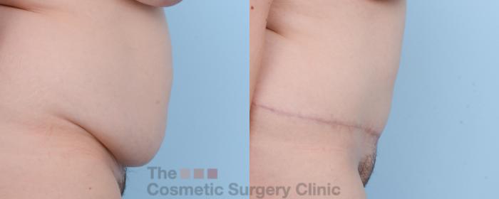 Before & After Tummy Tuck Case 457 View #4 View in Waterloo, Ontario