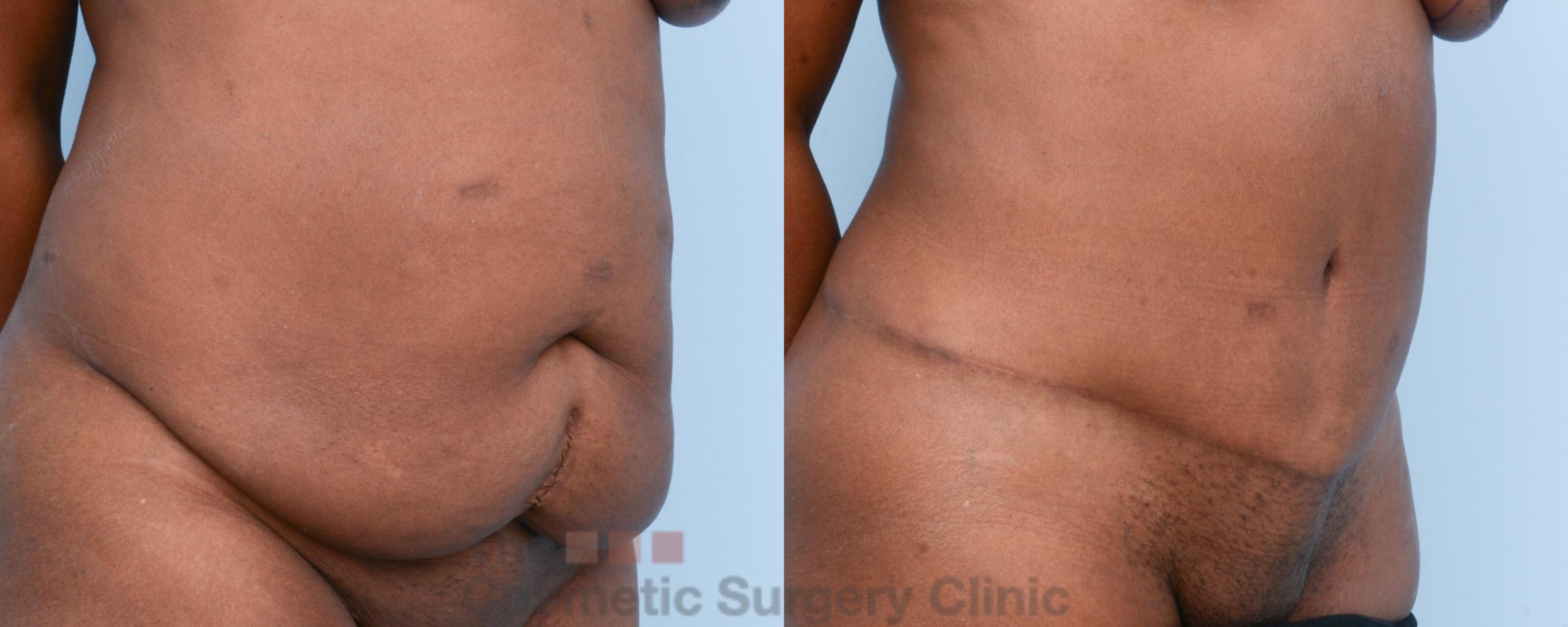 Before & After Tummy Tuck Case 495 View #4 View in Waterloo, Ontario