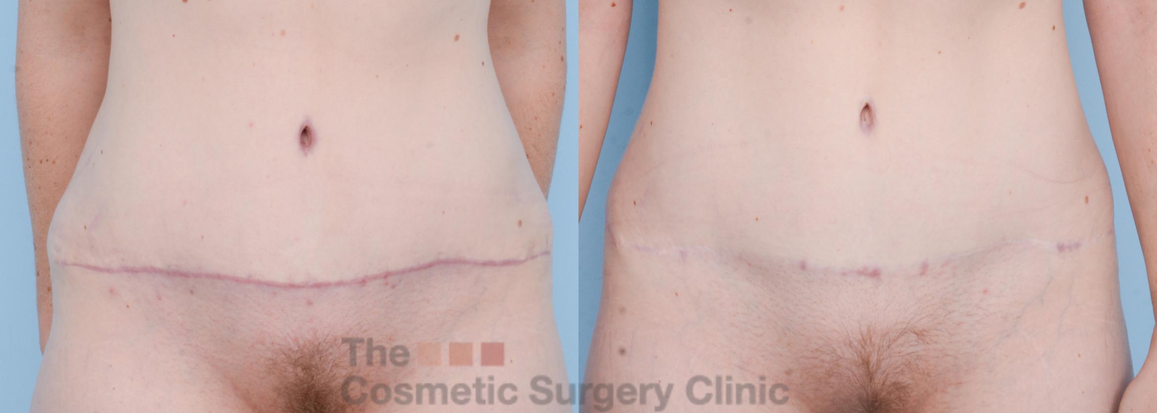 Before & After Tummy Tuck Case 506 View #6 View in Waterloo, Ontario