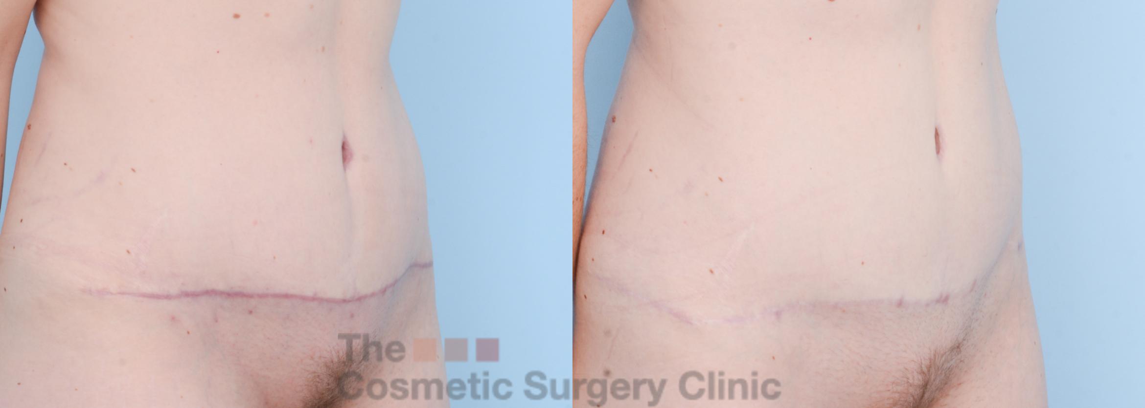 Before & After Tummy Tuck Case 506 View #9 View in Waterloo, Ontario