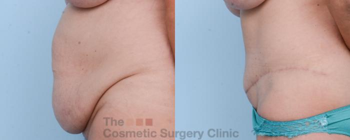 Before & After Tummy Tuck Case 529 View #2 View in Waterloo, Ontario