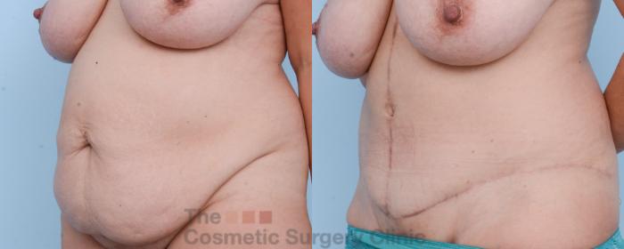 Before & After Tummy Tuck Case 529 View #3 View in Waterloo, Ontario