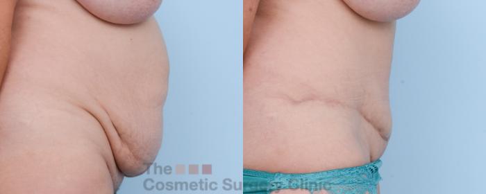 Before & After Tummy Tuck Case 529 View #5 View in Waterloo, Ontario