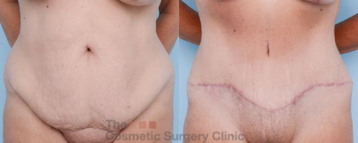Before & After Tummy Tuck Case 586 View #1 View in Waterloo, Ontario