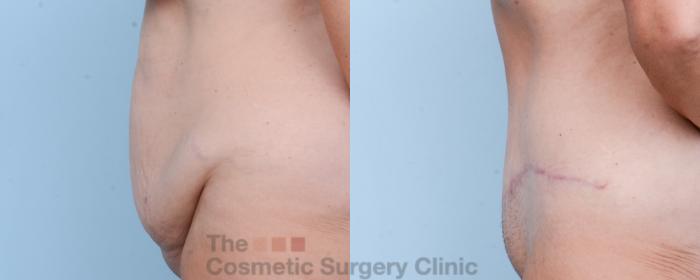 Before & After Tummy Tuck Case 586 View #2 View in Waterloo, Ontario